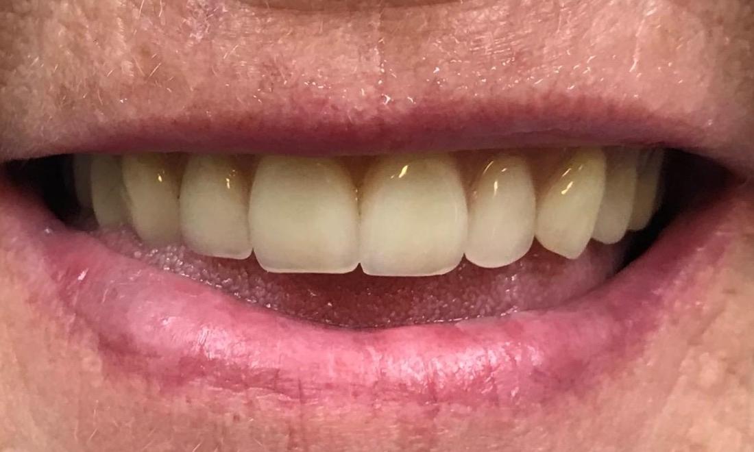 denture care morristown tennessee janapierala