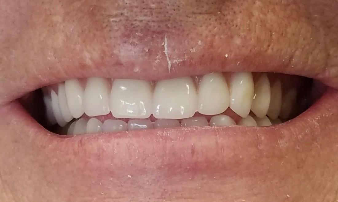 Dentures Before & After Photos Morristown TN
