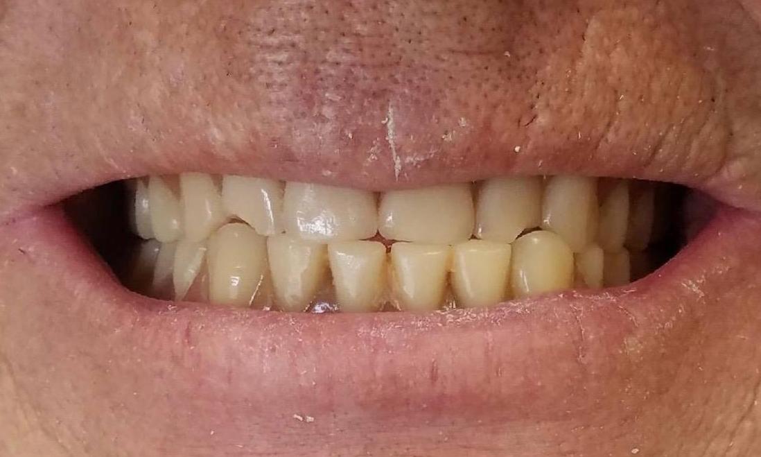 Dentures Before & After Photos Morristown TN